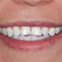Composite Bonding - Smile 23 before